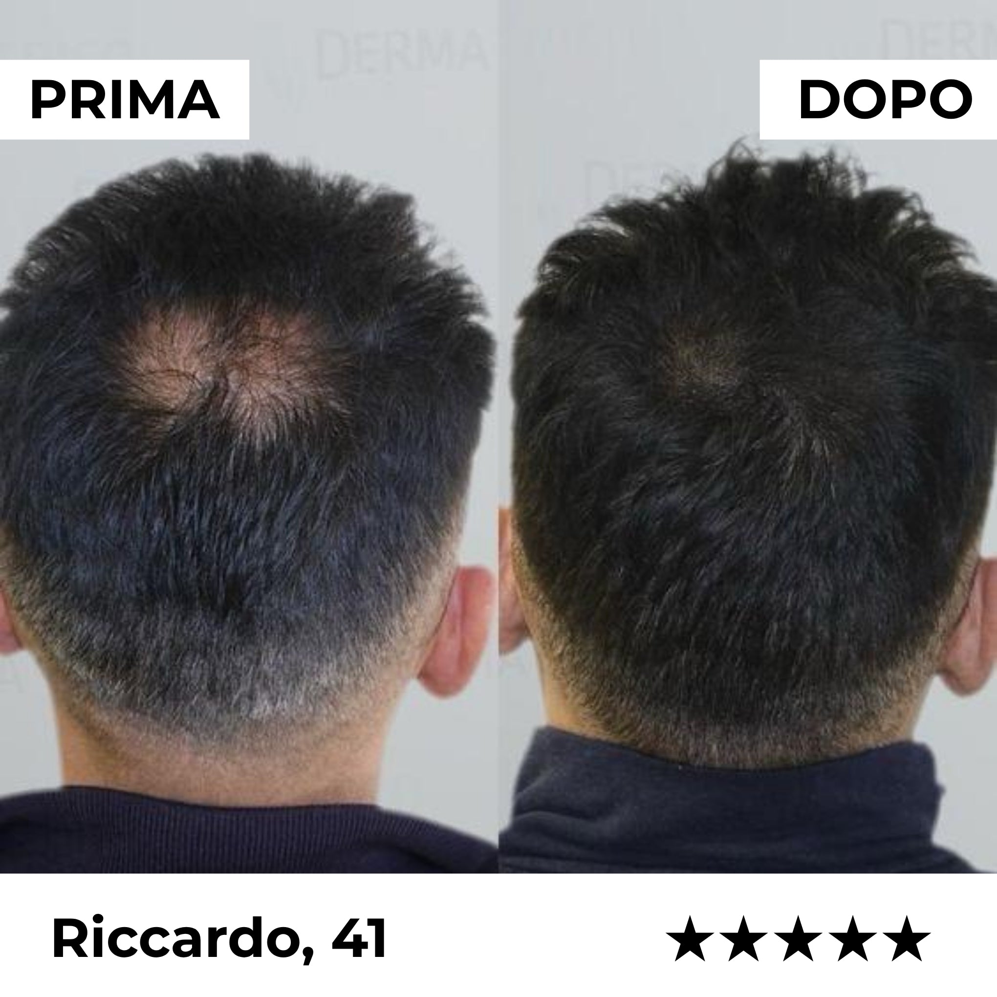 Sistema di Microinfusione Firmelià Uomo